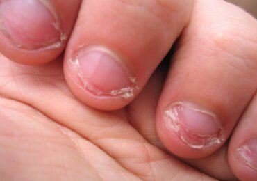 Pesquisadores comprovam que  roer as unhas faz mal à saúde