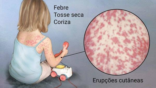 Brasil confirma mais de 10 mil casos de sarampo