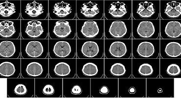 COVID-19 pode reduzir volume da massa cinzenta no cérebro