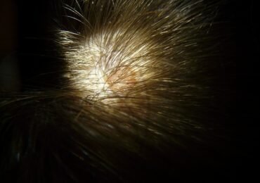 Câncer de pele também pode atingir o couro cabeludo